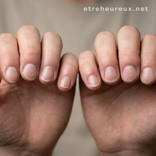 Hands showing swollen fingertips and curved nails associated with finger clubbing