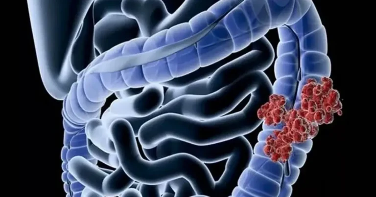 8-warning-signs-of-colon-cancer-your-body-may-be-s cover