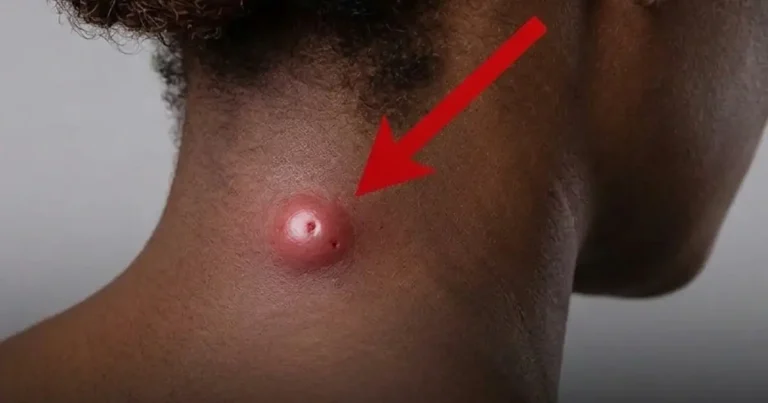 lump-on-your-neck-or-back-the-warning-signs-doctor cover