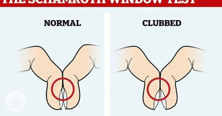the-simple-finger-test-that-could-flag-lung-cancer cover